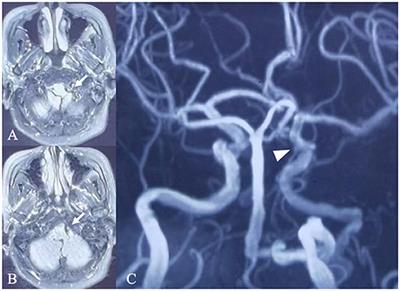 Concurrence of multiple aneurysms, extreme coiling of the extracranial internal carotid artery and ipsilateral persistent primitive hypoglossal artery: A case report and literature review